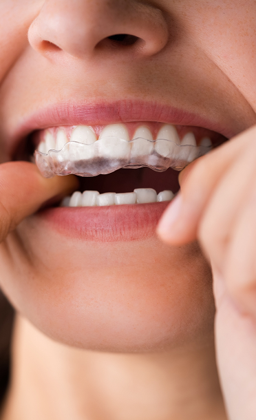 A person is applying Clear Braces and smiling