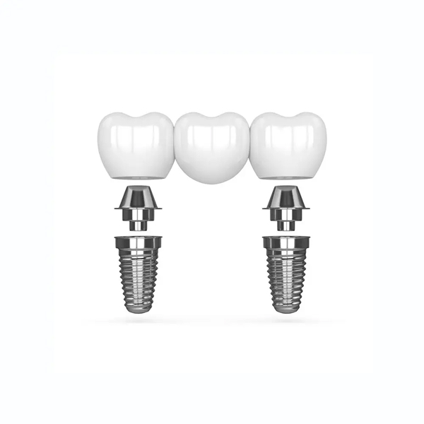 Multi Tooth Dental Implant