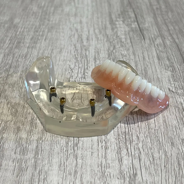 Snap-In-Implant Denture